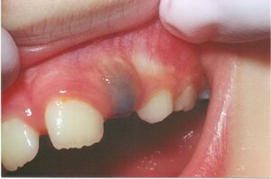 Почему начал болеть зуб внезапно и сильно